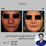 رینوپلاستی