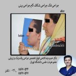 شکاف کام و لب