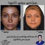 رینوپلاستی