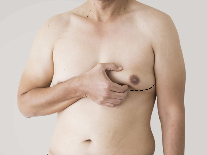جراحی کوچک کردن سینه در مردان ( ژنیکوماستی )
